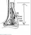 跟腱長(zhǎng)度怎么量。
