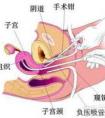 清宮手術(shù)需要休息多長時(shí)間？