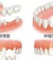 鑲牙和種植牙兩種方式有什么區(qū)別