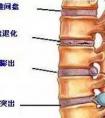 椎間盤膨出和腰間盤突出有什么區(qū)別