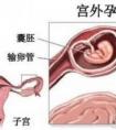 【宮外孕2號方】宮外孕ii號方