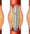 心臟支架?chē)?guó)產(chǎn)的和進(jìn)口的有什么區(qū)別？